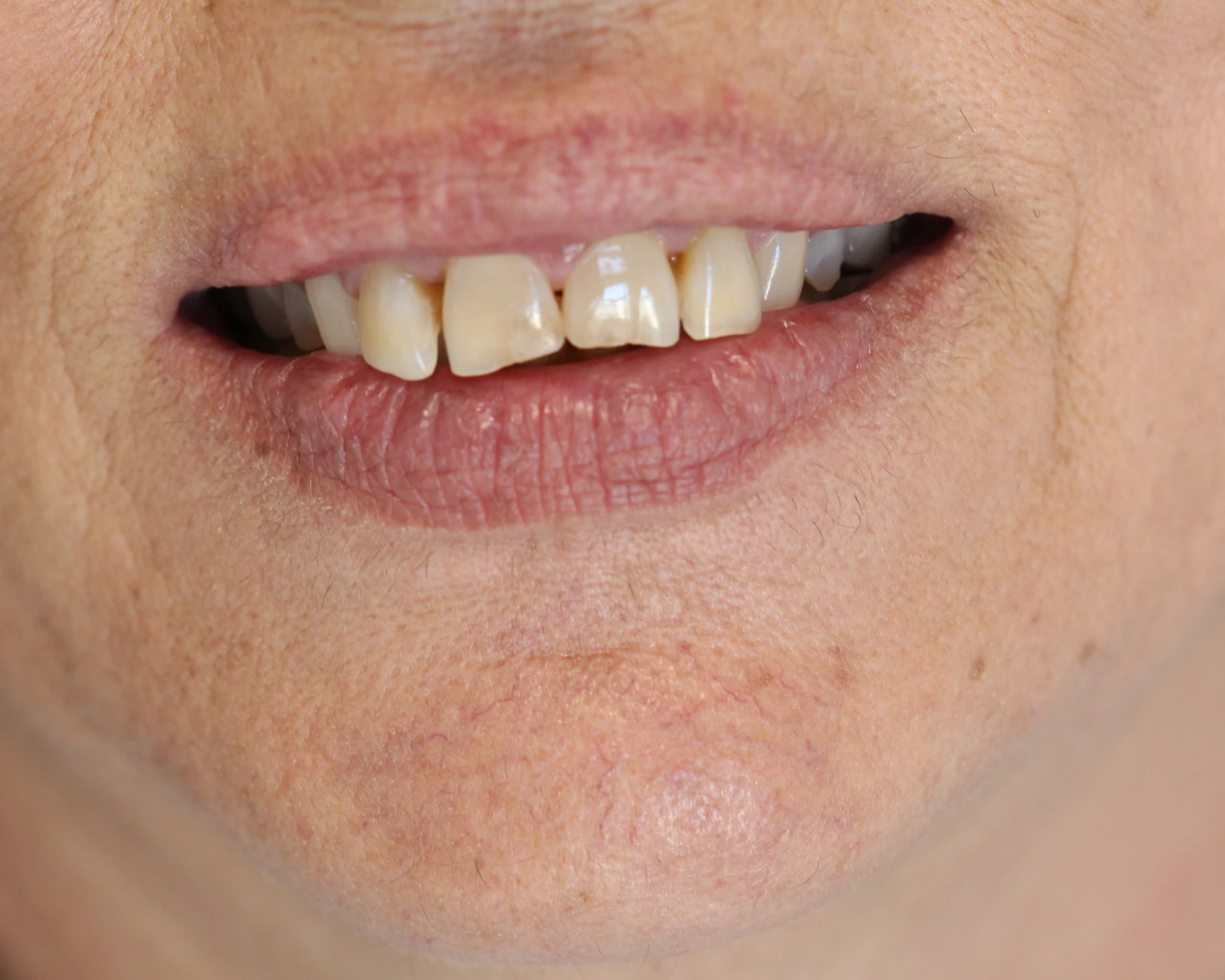 _1_veneers_1