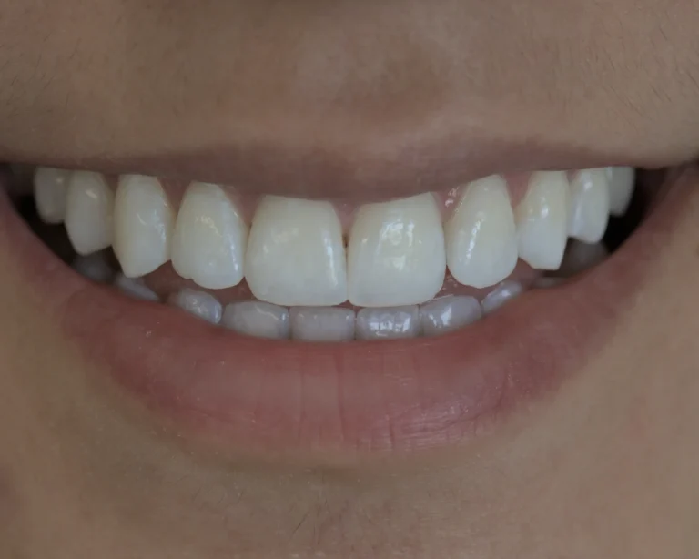 after whitening