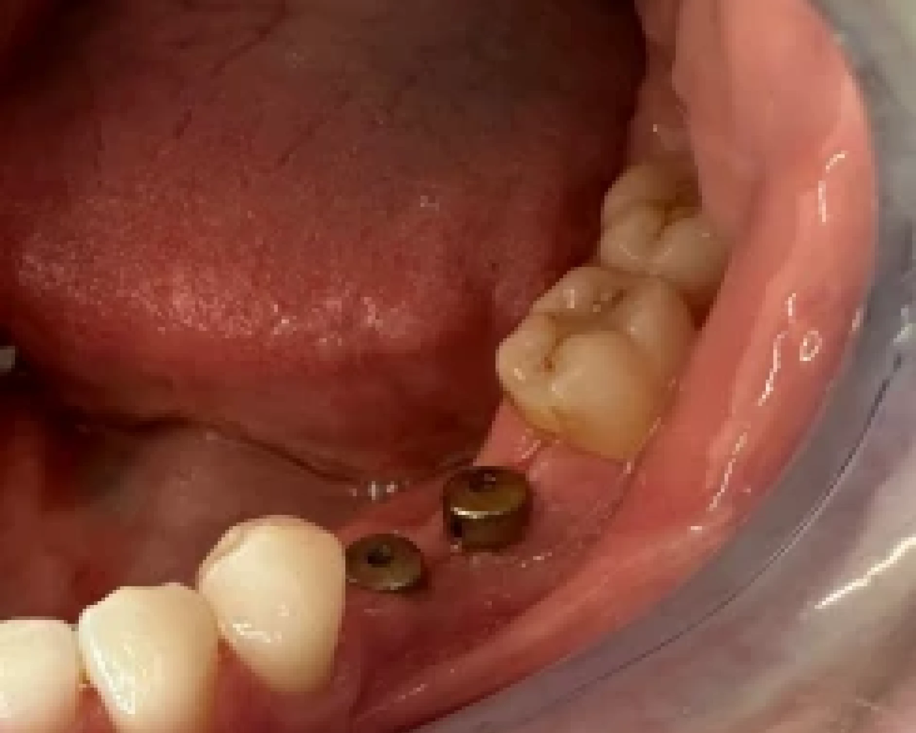 before implant