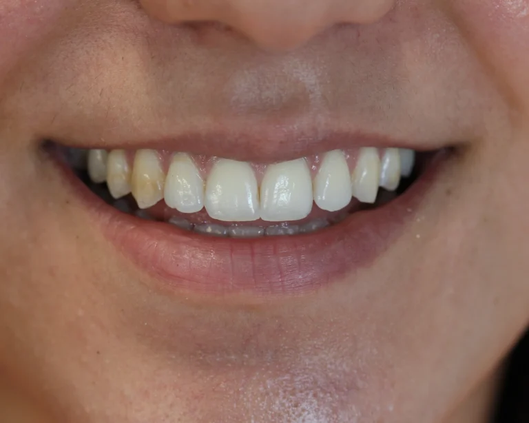 before whitening