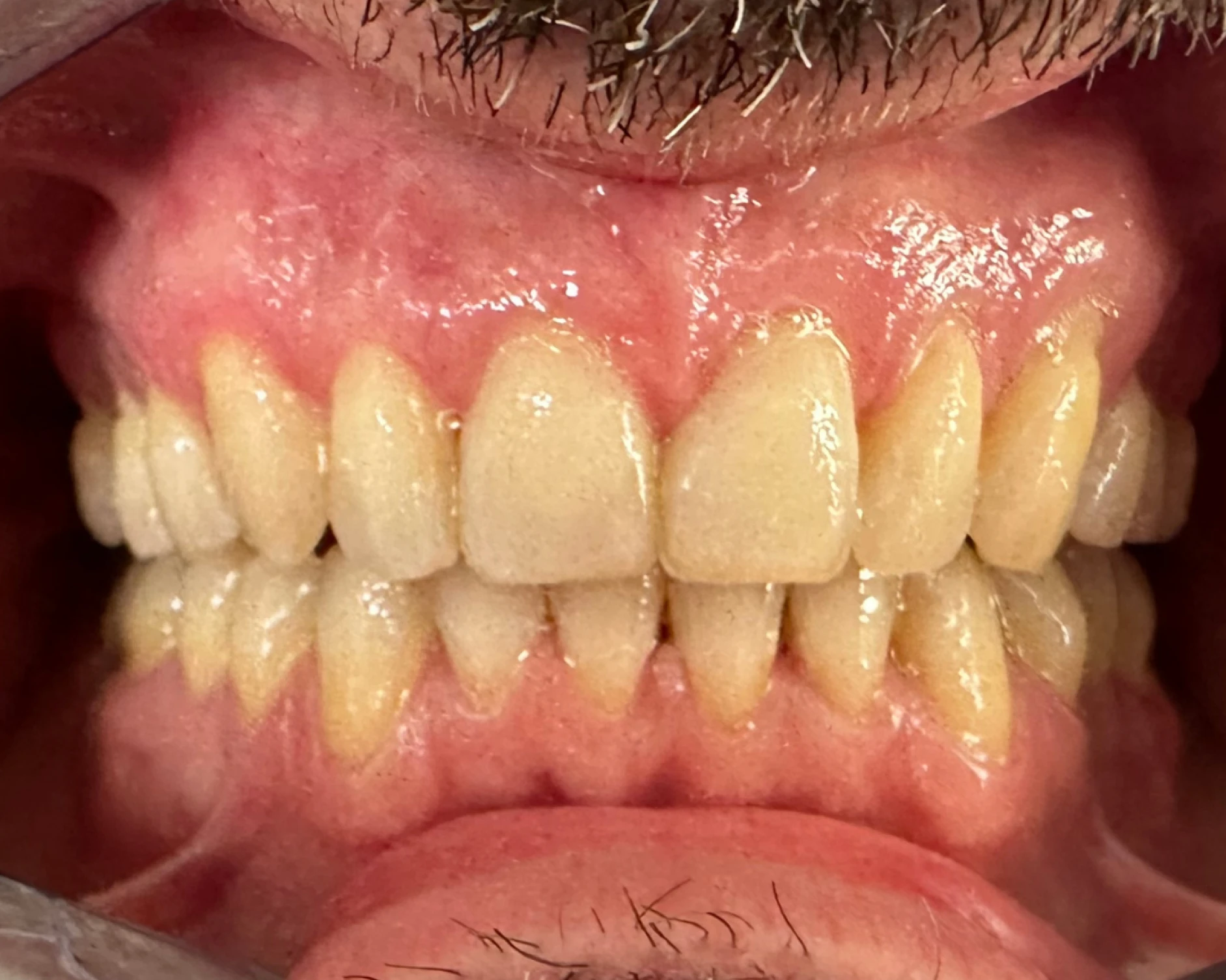 braces_off_4_1_1