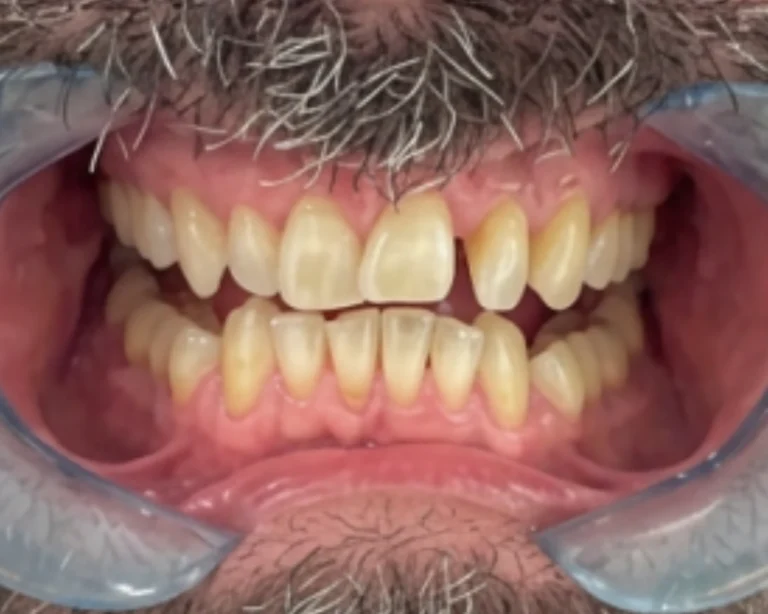 braces_off_5_1_1