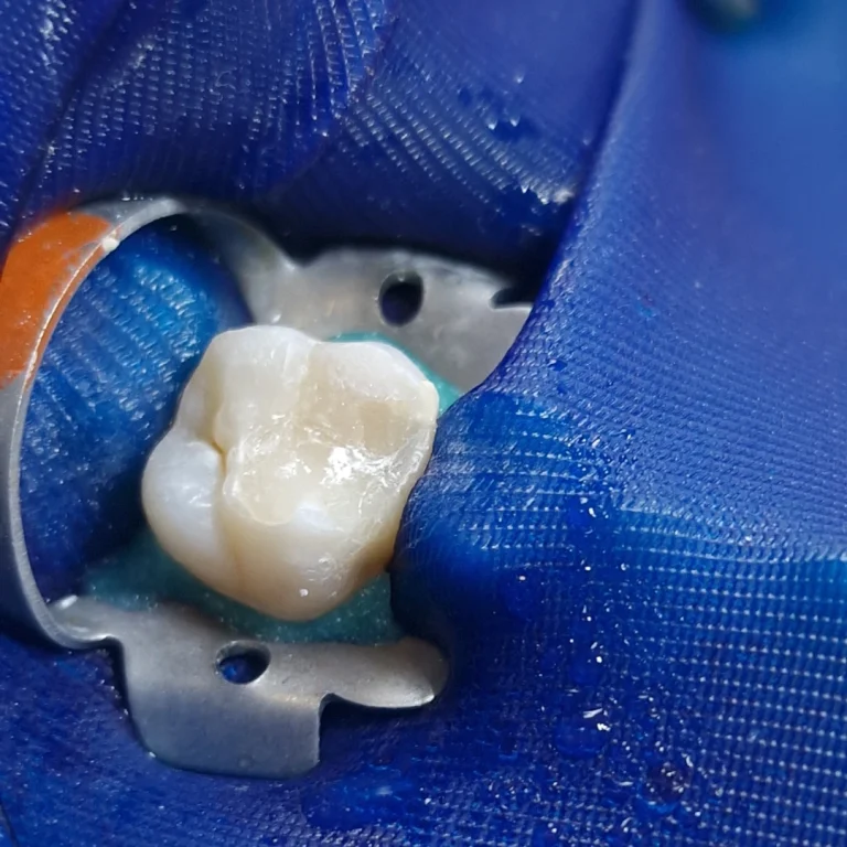 endo_tooth_closed_1