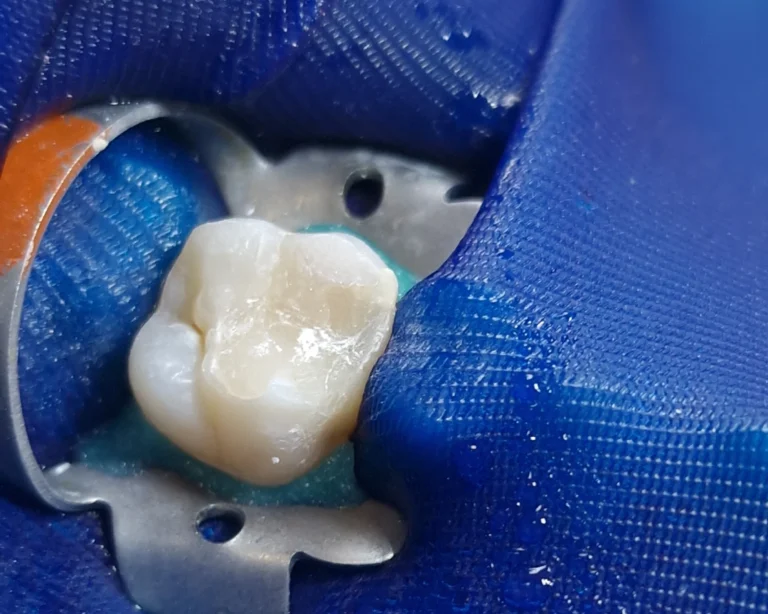 endo_tooth_closed_1_1