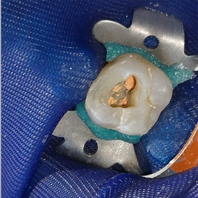 endo_tooth_open_1