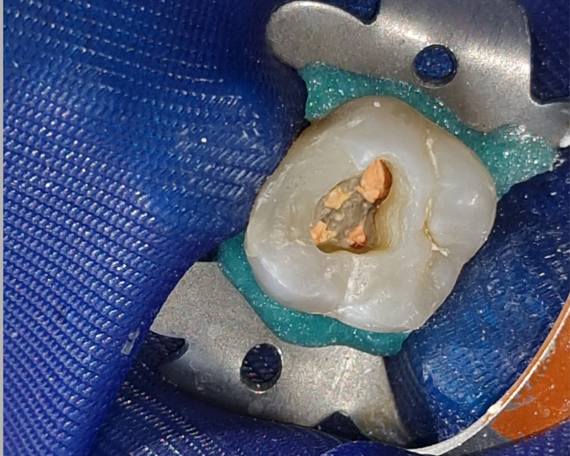 endo_tooth_open_1_1