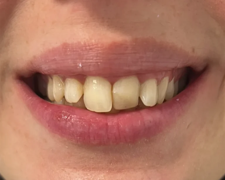 smile makeover