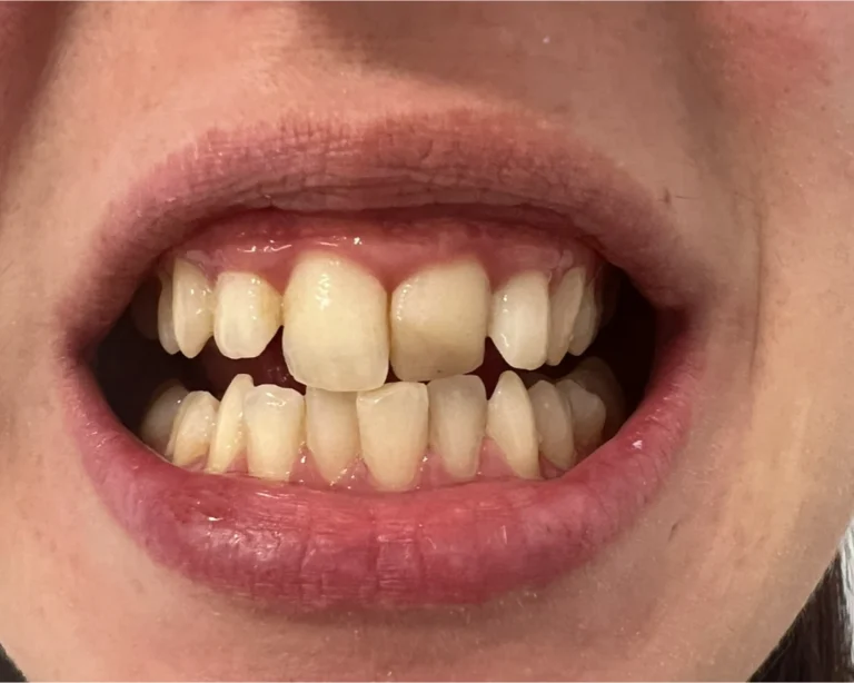 smile makeover_2