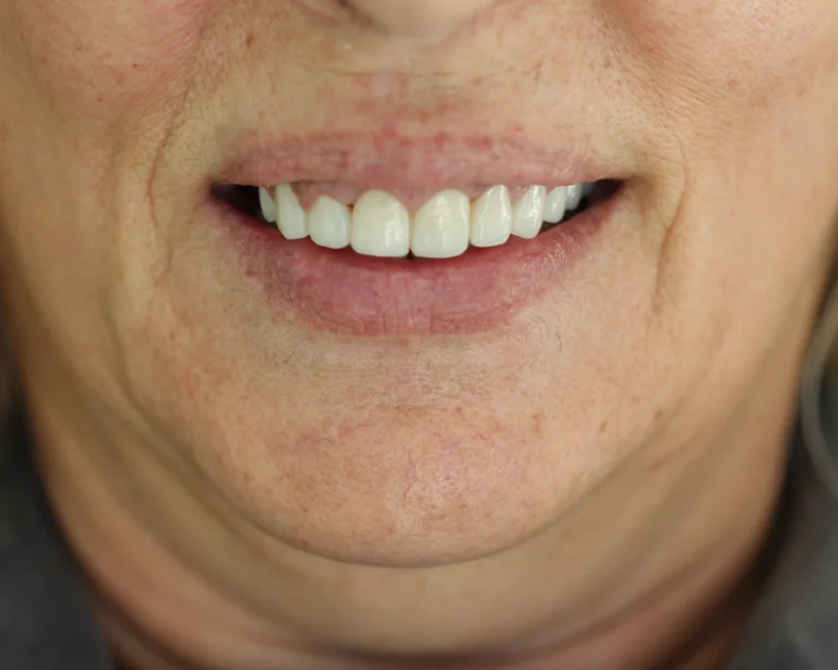 upper_jaw_final_veneers_1