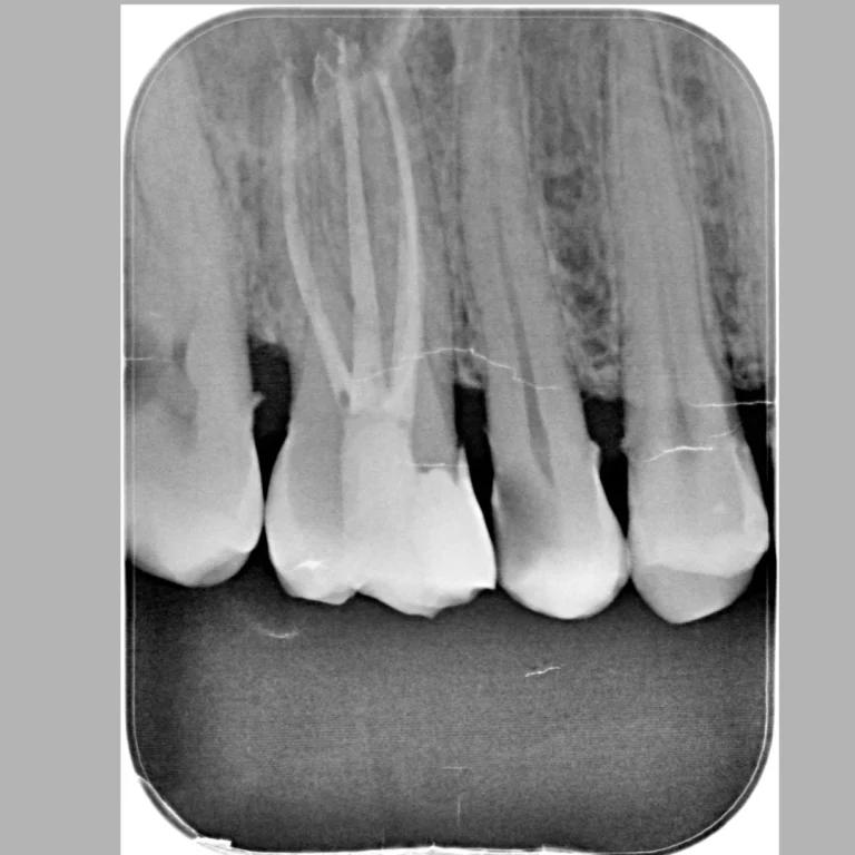 x_ray_endo_after_1