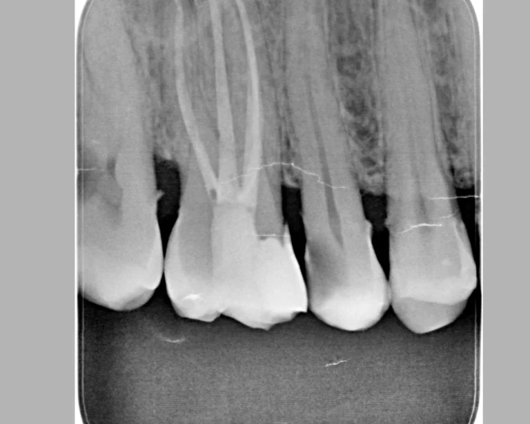 x_ray_endo_after_1_1