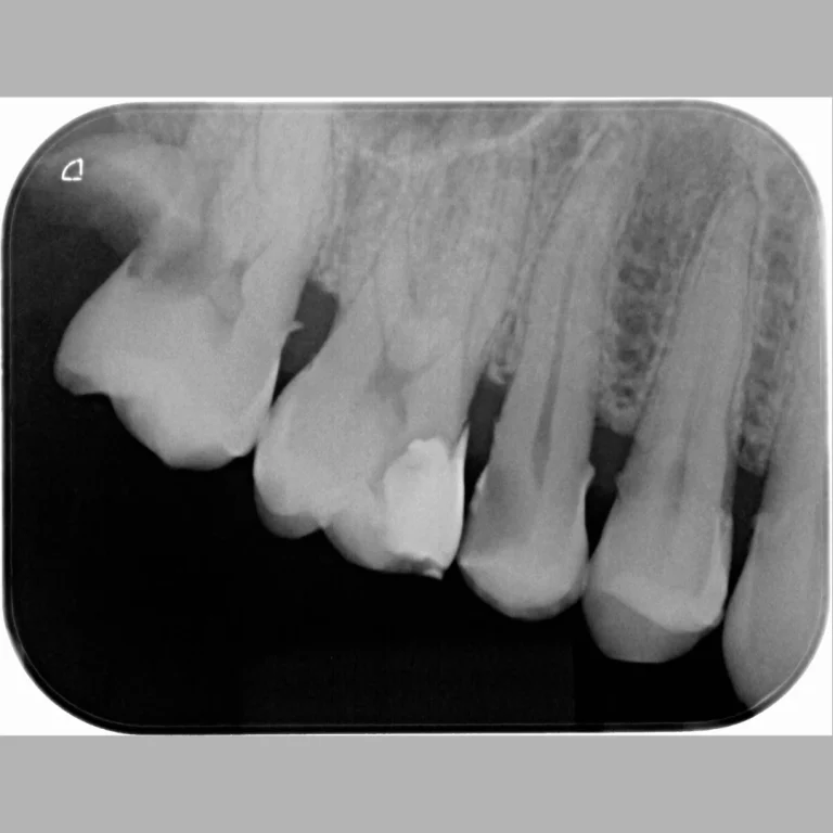 x_ray_endo_before_1