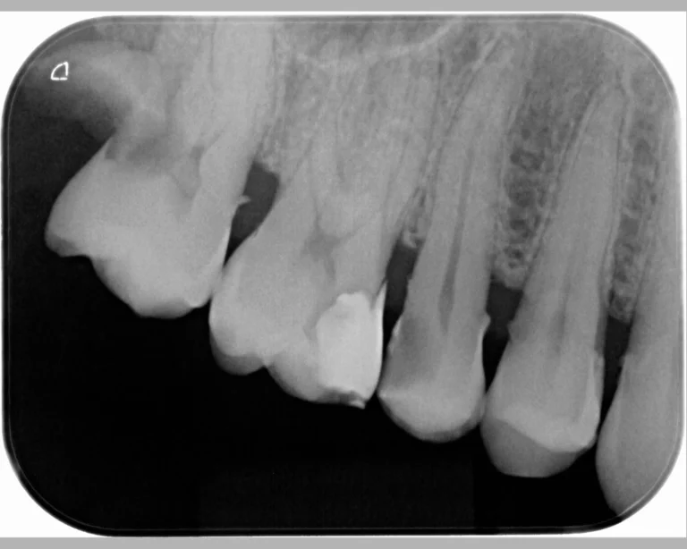 x_ray_endo_before_1_1