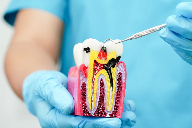 Root Canal