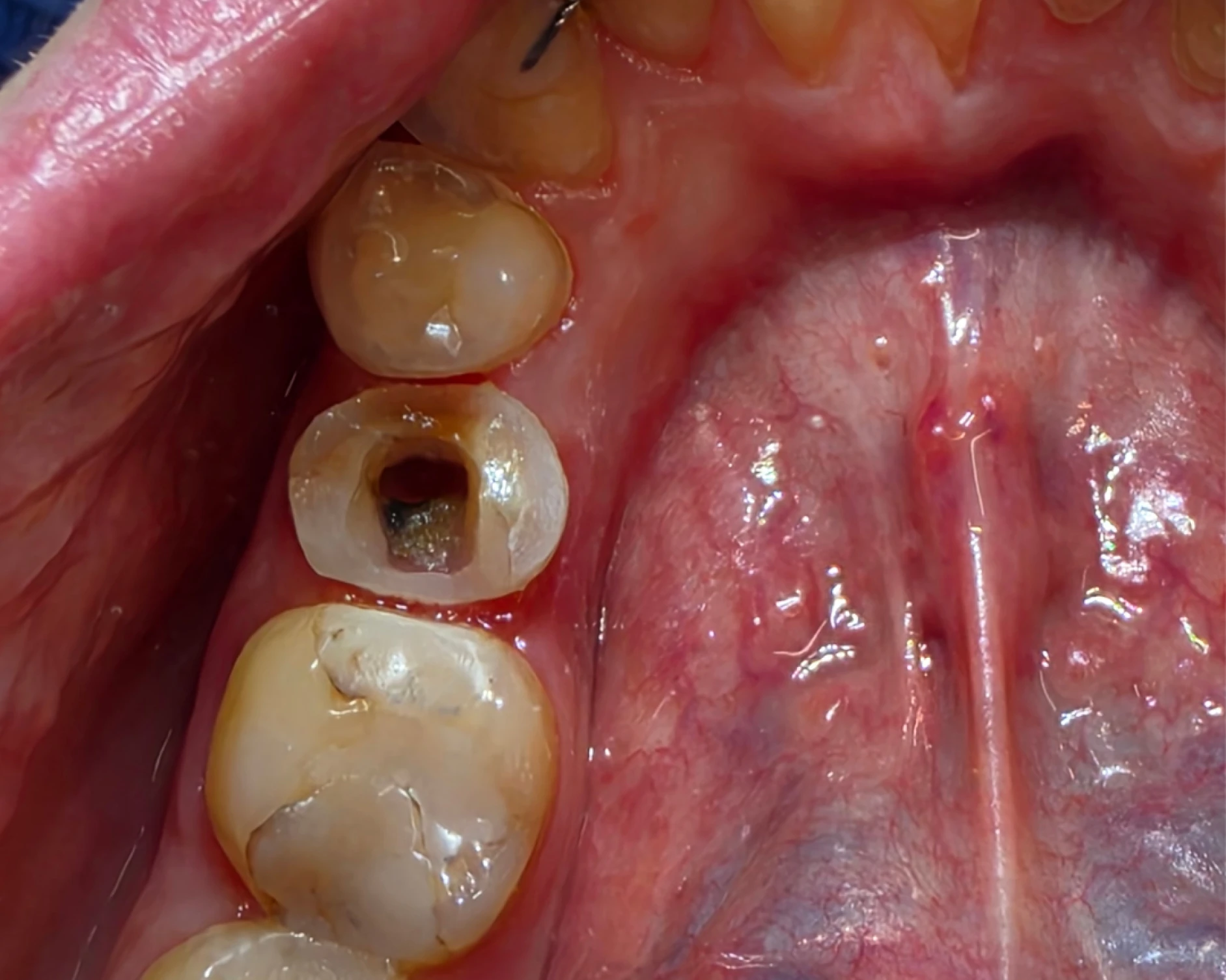 endo_crown_before_1